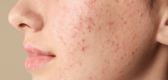 Salicylic acid